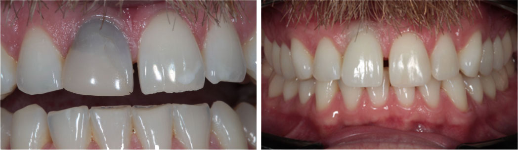 dentalimplants-after-before